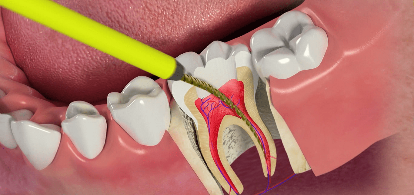 Endodontik Tedaviler (Kanal Tedavisi)